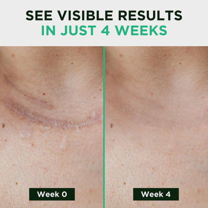 PureVa™ Silicone Scar Sheets